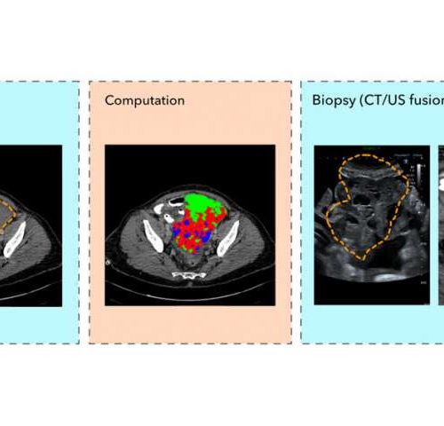 ‘Virtual biopsies’ could replace tissue biopsies in future thanks to technique developed by Cambridge scientists