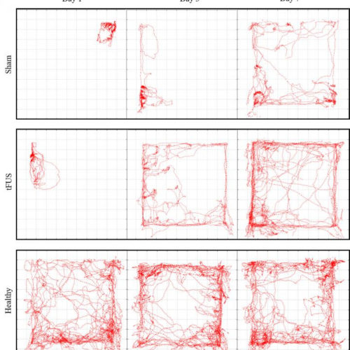 Nonsurgical treatment for cerebral infarction using wearable wireless ultrasound devices