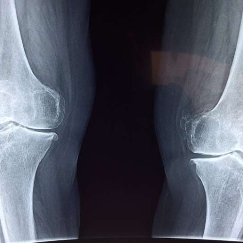 Target discovered that halts osteoarthritis-type knee cartilage degeneration