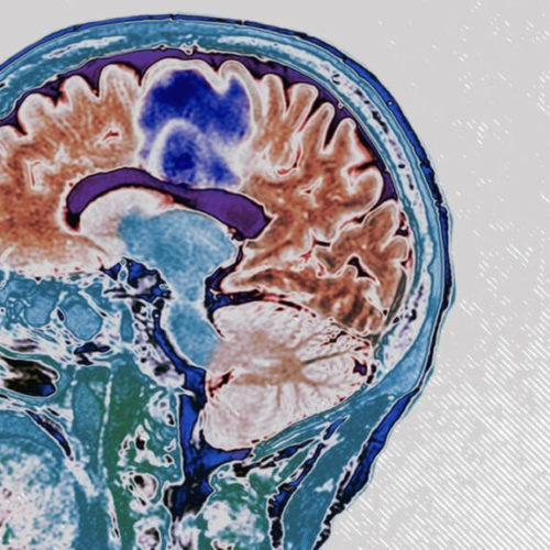 Existing drugs may cut off ‘fuel supply’ to an aggressive brain cancer