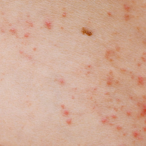 What can cause red dots to appear on the skin?