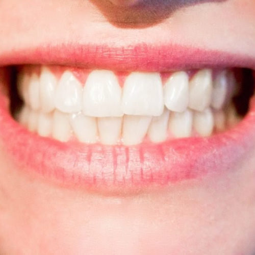 Microbiome study: Gum disease-causing bacteria borrow growth molecules from neighbors to thrive