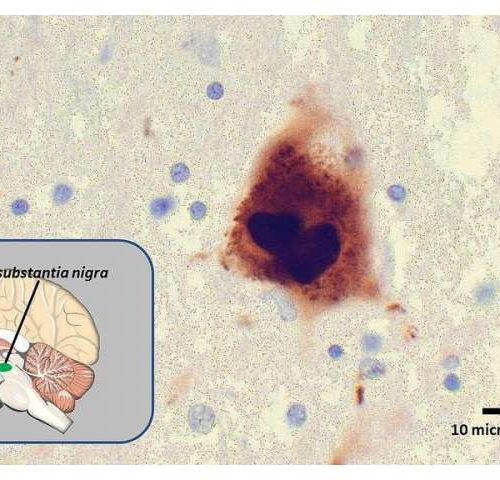 Artificial enzyme may be first step toward treatment for Parkinson’s disease