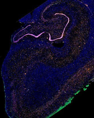 Brain Cells Most Vulnerable to Alzheimer’s Disease Identified by Scientists