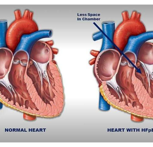 Obesity weakens heart muscle in patients with a common type of heart failure