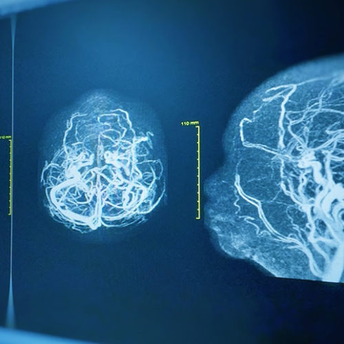 Thinning, Leaky Brain Blood Vessels Seen in COVID-19