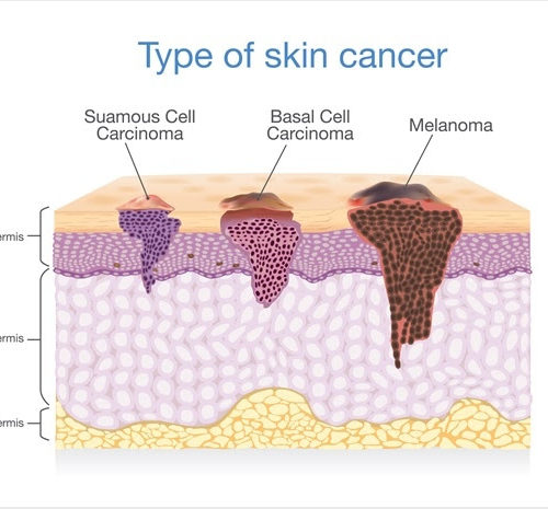 DermaSensors: The Future of Skin Cancer Detection