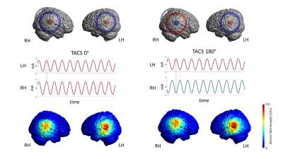 Changing the connection between the hemispheres affects speech perception