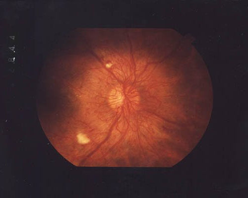 Discovery of a new drug for diabetic retinopathy