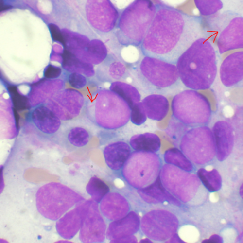 Researchers discover mechanism to overcome drug-resistance in leukemia