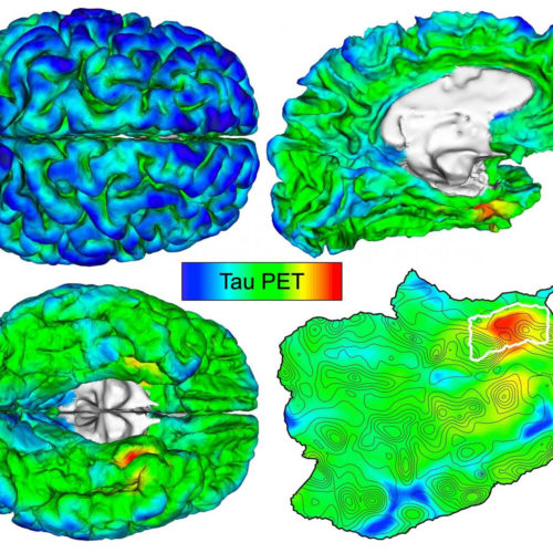 Automated imaging detects and tracks brain protein involved in Alzheimer’s disease