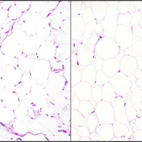 New test provides fast and accurate diagnosis of liposarcomas