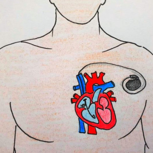 New piezoelectric generators will make self-powered pacemakers possible