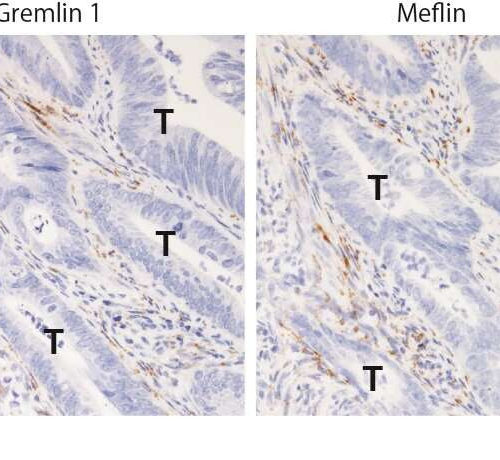 Study finds potential therapeutic targets to inhibit colorectal cancer progression