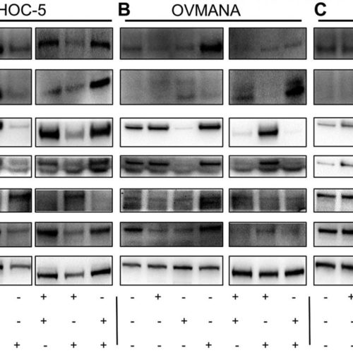 Oncotarget: Simvastatin is a potential candidate drug in ovarian clear cell carcinomas