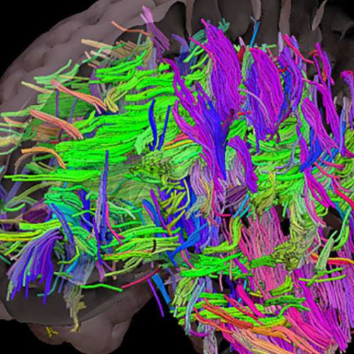 Obesity may exacerbate the effects of Alzheimer’s disease, new study shows