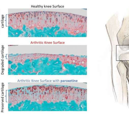 Common anti-depressant may be first-ever treatment for osteoarthritis