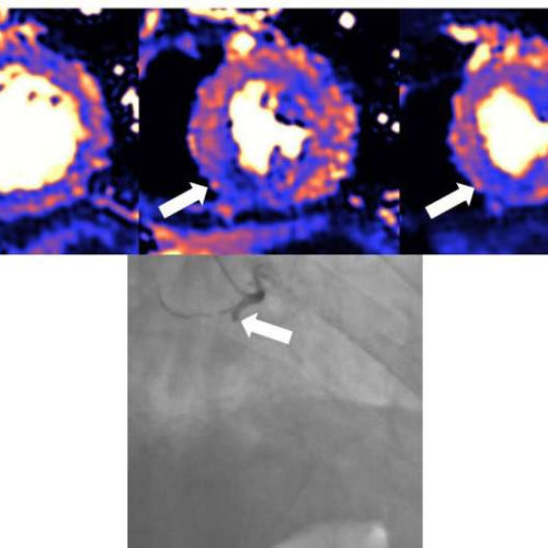 Damage to the heart found in more than half of COVID-19 patients discharged from hospital