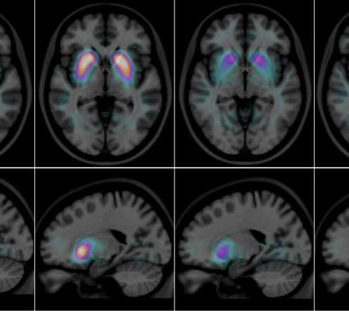 Imaging of a living brain can help clearly differentiate between two types of dementia