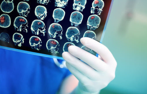 Injecting bone marrow into brain could help stroke patients recover faster, breakthrough study shows