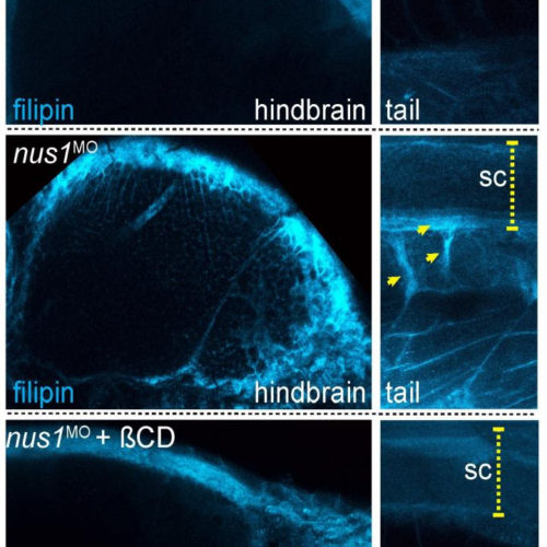 Cholesterol accumulation contributes to genetic movement disorder