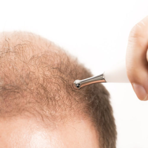 Unbalanced cell division offers a new target for treating baldness