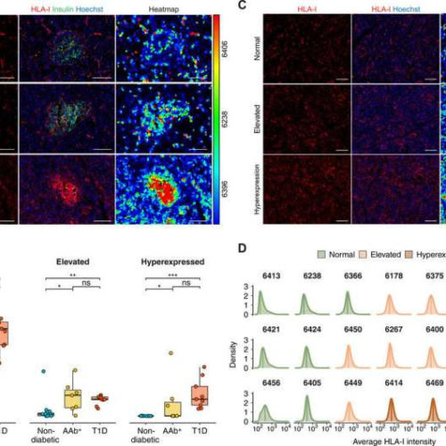 Relationship between type 1 diabetes, interferon response and viral infection is first step toward preventive therapies