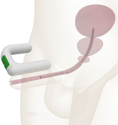 Wireless Smart Catheter for Bladder Control: Interview with Matt Monarski, CEO of UroDev Medical