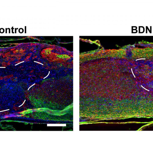 Injectable porous scaffolds promote better, quicker healing after spinal cord injuries