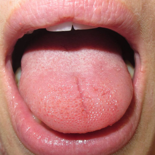 This strange condition could explain why your tongue feels weird