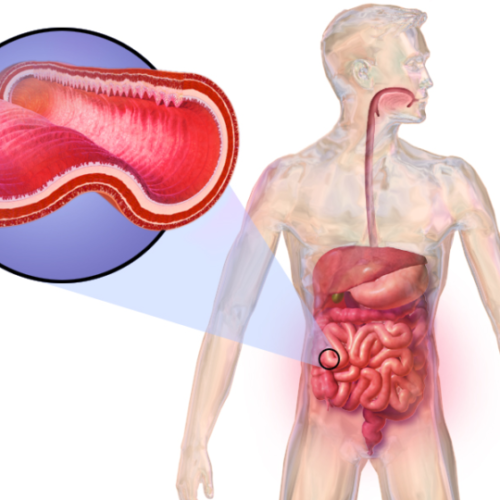 Study finds ‘Achilles’ heel’ of Crohn’s-linked bacteria