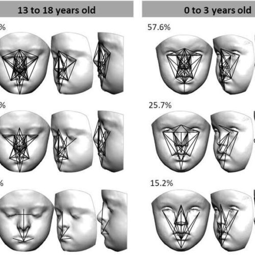 Green tea supplements modulate facial development of children with Down syndrome