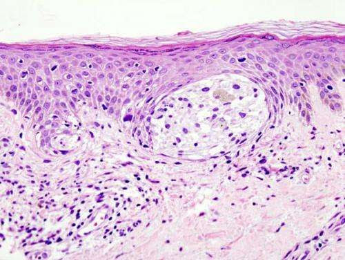 Predicting mutated gene associated with melanoma