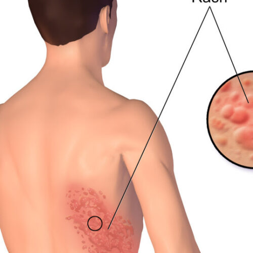 New vaccine side effect? In Israel, six people develop herpes zoster