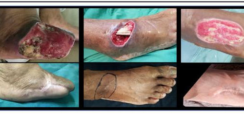 Stem cell therapy research could help patients with non-healing diabetic foot ulcers