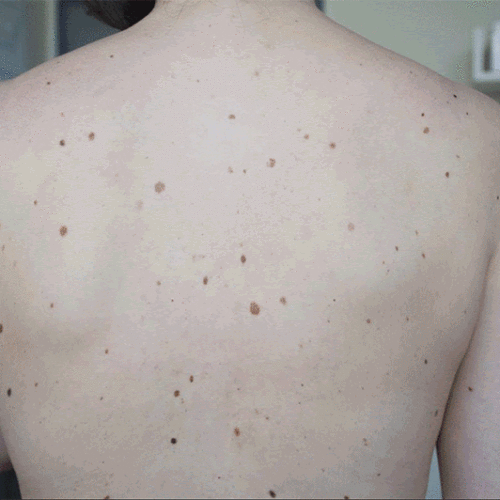 Software Spots Suspicious Skin Lesions on Smartphone Photos