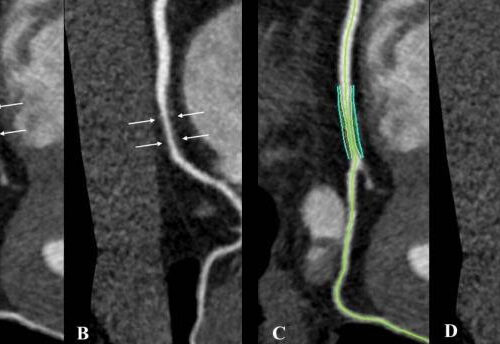 Noncalcified coronary plaque burden higher in people with HIV