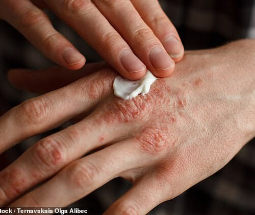 Latest remedy for eczema — rub bacteria on to your skin!