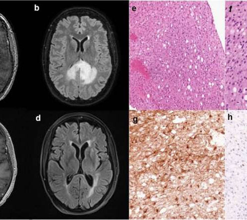 Case study of rare nervous system tumor reveals hypermutation