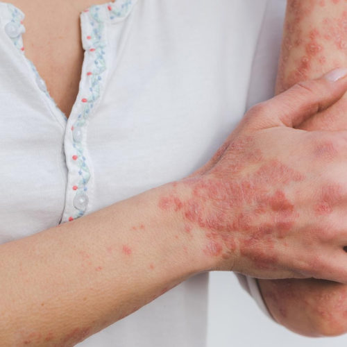 Relationship between psoriasis treatments and cardiovascular risk explained