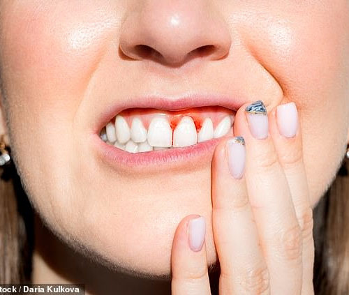 Adults who suffer from gum disease are TWICE as likely to have high blood pressure, study warns