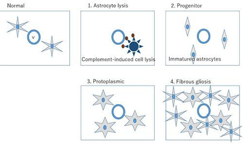 Classification scheme developed for newly identified multiple sclerosis-like disease