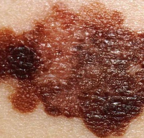 Dual drug approach to treat deadly melanoma