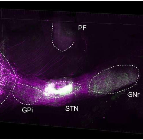 Distinct Parkinson’s disease symptoms tied to different brain pathways