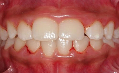 Bacteria that cause periodontitis are transmitted from parents to children