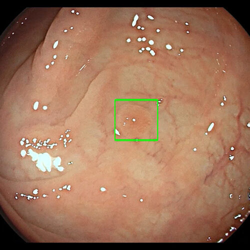 FDA Clears First AI Polyp Detection System for Colonoscopies