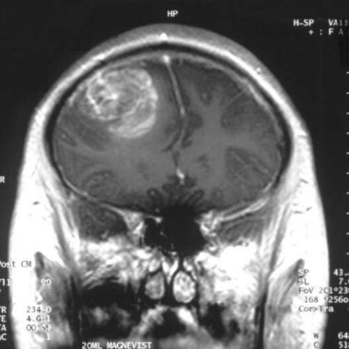 Protein variant may have potential as target for glioblastoma