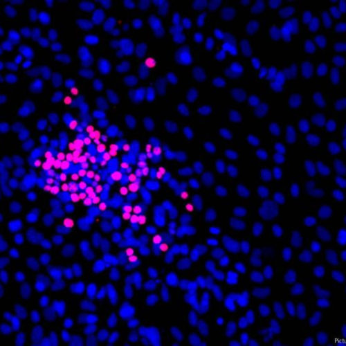 Small cell lung cancer: Scientists identify two new approaches for therapy