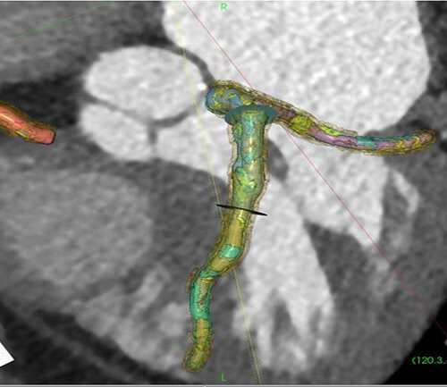 Researchers at MUSC use AI software to predict coronary artery plaque composition and significance without the risks of invasive procedures