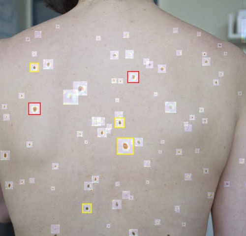 An artificial intelligence tool that can help detect melanoma